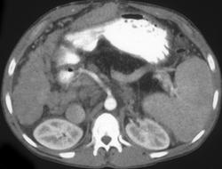 Hepatoma (dual Phase Study) - CTisus CT Scan