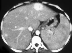 Arteriovenous Malformations (AVMs) in Osler Weber Rendu - CTisus CT Scan