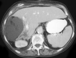 Metastases W/adjacent Flow Changes - CTisus CT Scan