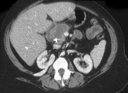 Vascular Metastases - CTisus CT Scan