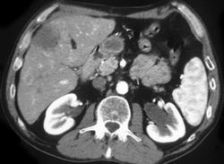 Colon Cancer Metastatic to the Liver (dual Phase) - CTisus CT Scan