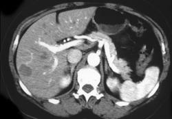 Biliary Cirrhosis W/varices - CTisus CT Scan