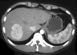 Cirrhosis - CTisus CT Scan