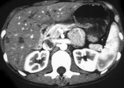 Carolis Disease - CTisus CT Scan