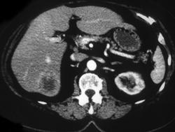 Portal Vein Thrombosis W/delayed Flow - CTisus CT Scan