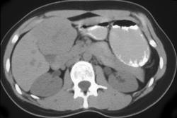 Hepatoma - CTisus CT Scan