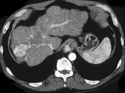 Metastatic Biliary Cystadenoma - CTisus CT Scan