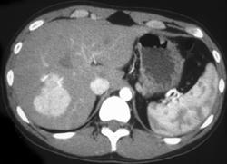 Hepatic Adenomas - CTisus CT Scan