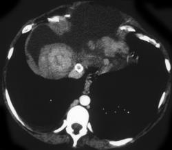 Focal Nodular Hyperplasia - CTisus CT Scan