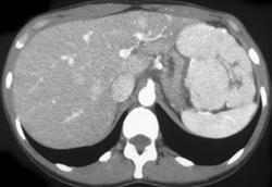 Dense Liver Due to Amiodarone - CTisus CT Scan