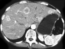 Liver Infarct S/P Chemoembolization - CTisus CT Scan