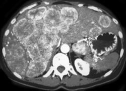 Cholangiocarcinoma - CTisus CT Scan