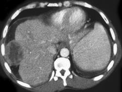 Hemangioma - CTisus CT Scan