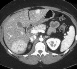 Cirrhosis - CTisus CT Scan