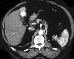 Gallbladder Cancer - CTisus CT Scan