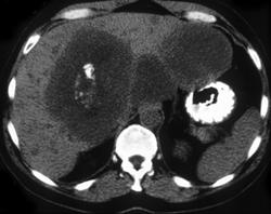 Hepatoma S/P Embolization - CTisus CT Scan