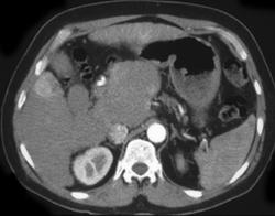 Pre-tx Evaluation - CTisus CT Scan