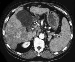 Post Embolization of A Hepatoma - CTisus CT Scan