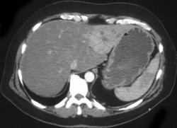 Cirrhosis - CTisus CT Scan