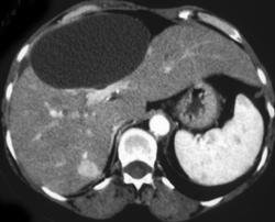 Hepatic Adenoma - CTisus CT Scan