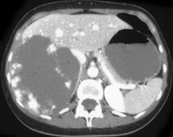 Hepatic Adenoma - CTisus CT Scan