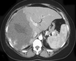 Hepatic Adenoma - CTisus CT Scan