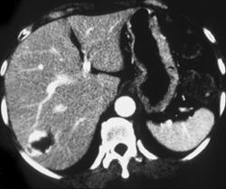 Hepatic Adenoma - CTisus CT Scan