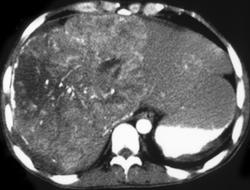 Cirrhosis - CTisus CT Scan