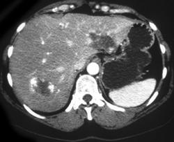 Infected Portal Vein Thrombosis - CTisus CT Scan