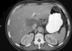 Fatty Liver - CTisus CT Scan