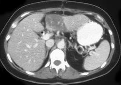 Metastatic Testicular Cancer to Liver W/bleed - CTisus CT Scan