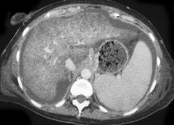 Dual Phase Liver (normal) - CTisus CT Scan