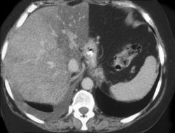 Infiltrating Hepatoma - CTisus CT Scan