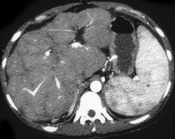 Hepatoma - CTisus CT Scan