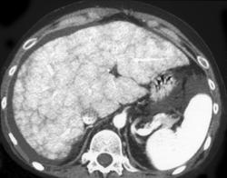 Cirrhosis - CTisus CT Scan