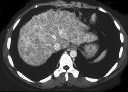 Cirrhosis - CTisus CT Scan