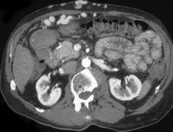 Radiation Changes in Liver - CTisus CT Scan