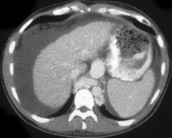 Cirrhosis - CTisus CT Scan