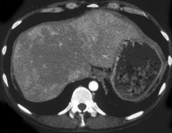 Acute Cholecystitis - CTisus CT Scan