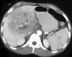 Gallbladder Cancer - CTisus CT Scan