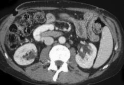 Hepatoma - CTisus CT Scan