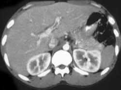 Liver Abscess - CTisus CT Scan