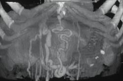 Cirrhosis (dual Phase) - CTisus CT Scan