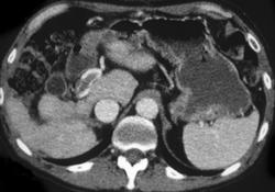 Hepatic Adenoma - CTisus CT Scan