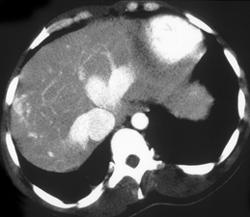 Liver Abscess - CTisus CT Scan