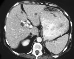 Post Cryosurgery - CTisus CT Scan