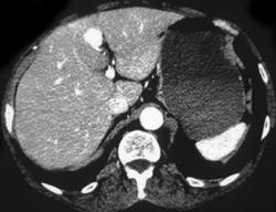 Focal Nodular Hyperplasia (FNH) - CTisus CT Scan