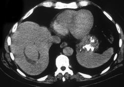 Necrotic Metastases & Abscess - CTisus CT Scan