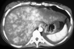 Liver Laceration - CTisus CT Scan