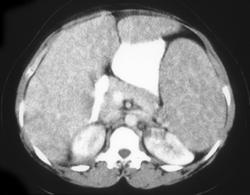 Liver Laceration - CTisus CT Scan